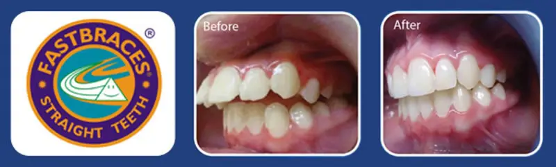 FastBraces Before & After Transformation