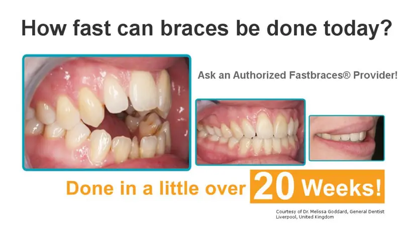 Transformation With FastBraces