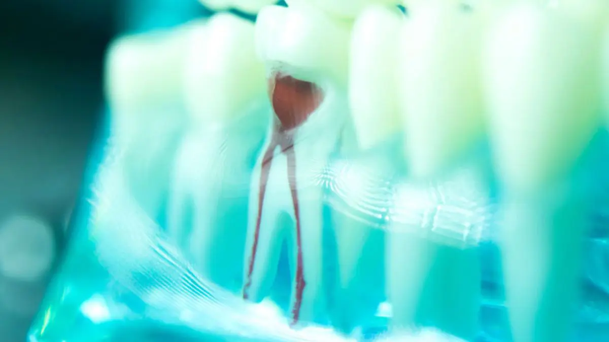 Close-up Of A Root Canal