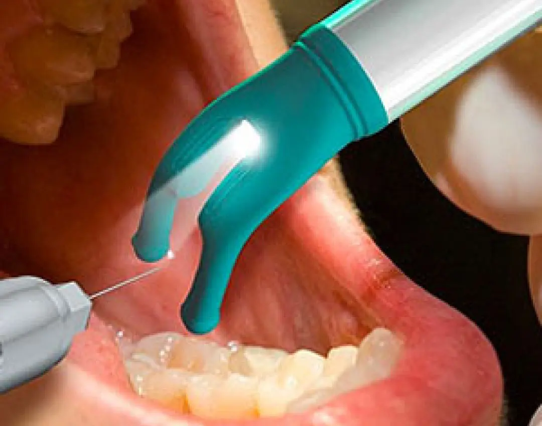 DentalVibe® Treatment In London, ON